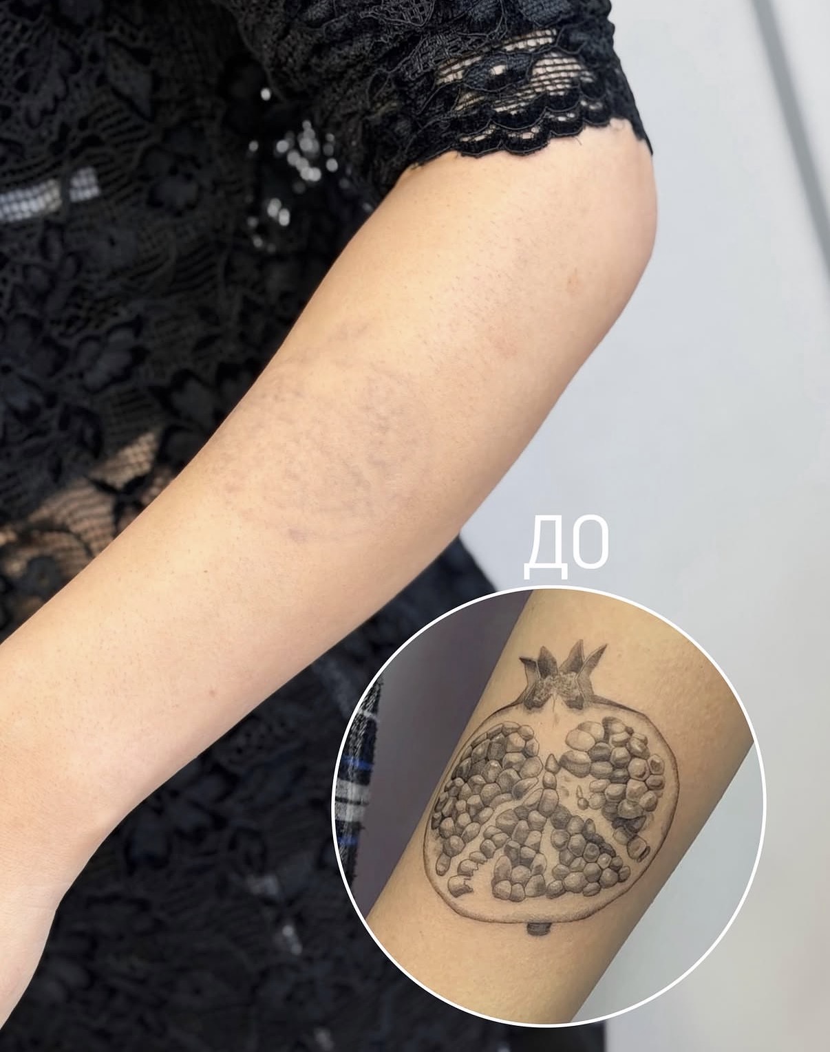 Удаление крупной татуировки на плече