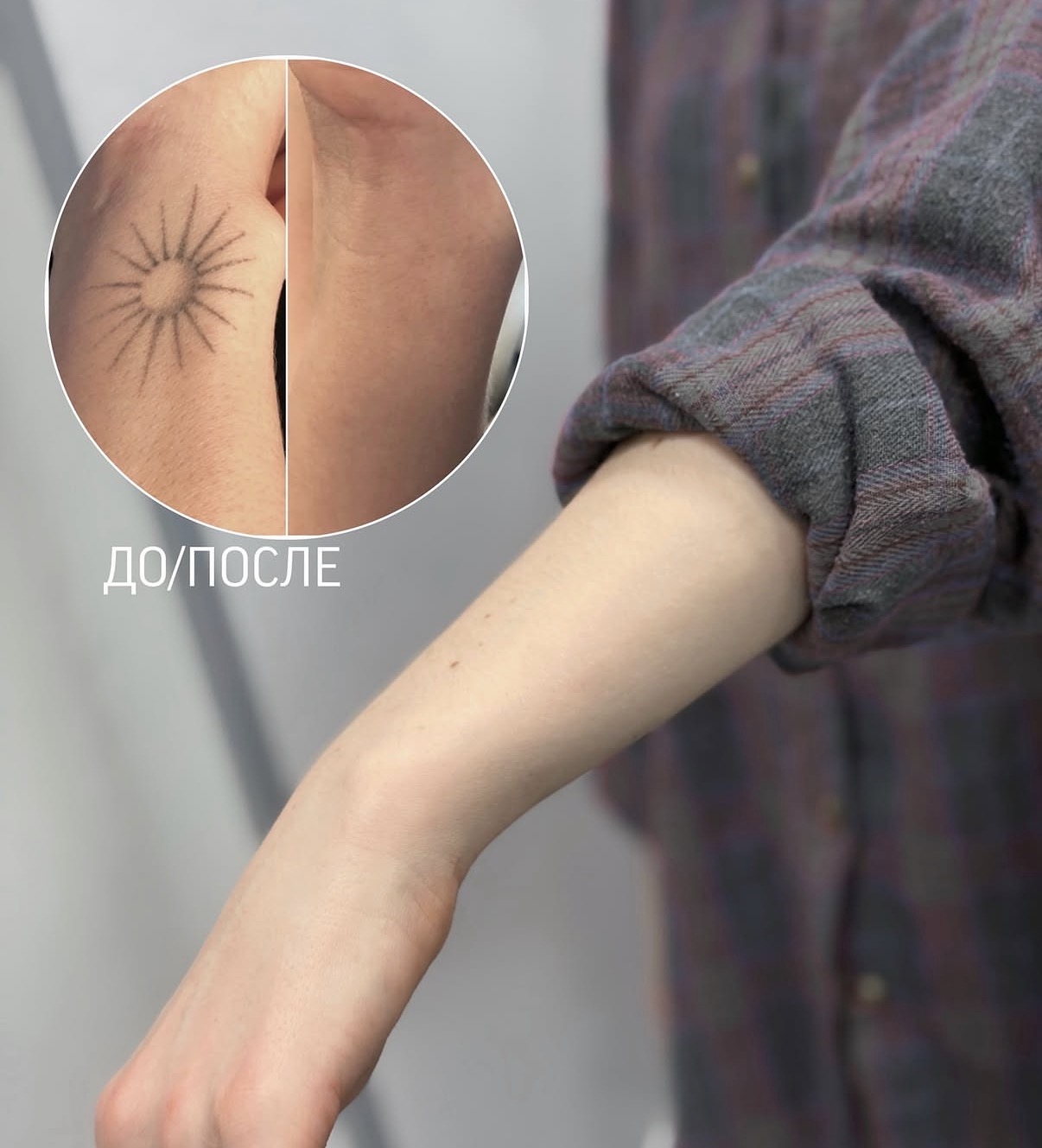 Удаление татуировки на руке — до/после
